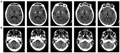 Balance Impairment in Fahr’s Disease: Mixed Signs of Parkinsonism and Cerebellar Disorder. A Case Study